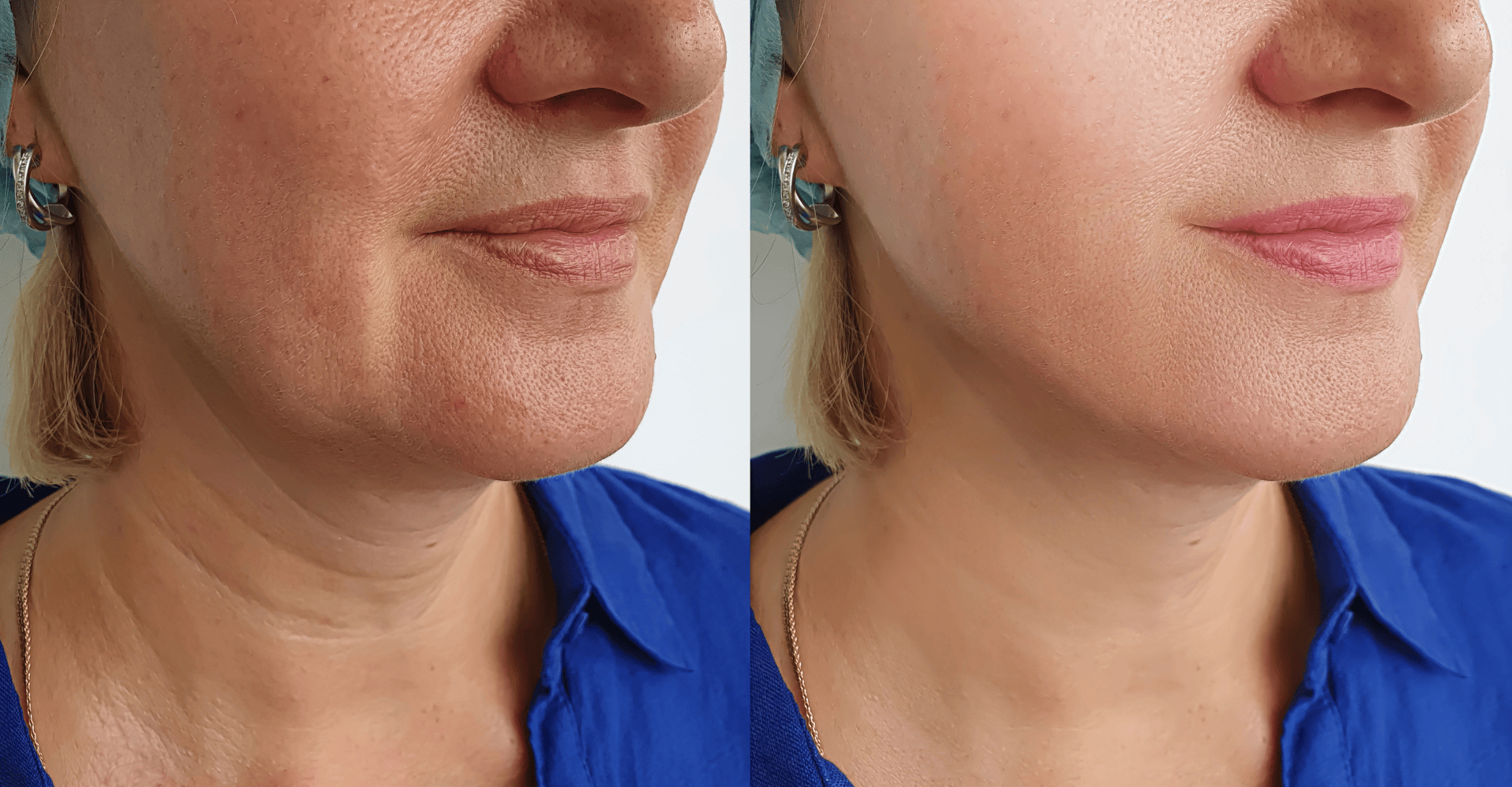 Sculptra vs. Hyaluronic Acid Fillers: The Next Level of Facial Rejuvenation