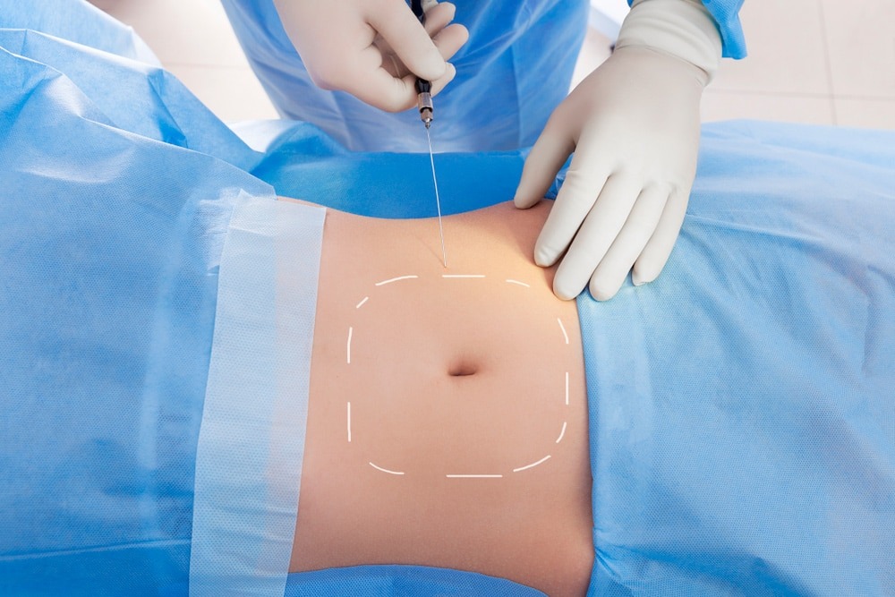 Non-Invasive Smart Laser Liposuction with AI Technology
