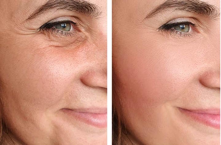 Non-Surgical Face Lift — The Ultimate Full-Face Regeneration Protocol
