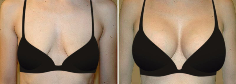 Non-Surgical Breast Lift with PRF