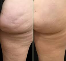Cellulite Treatment with Avéli