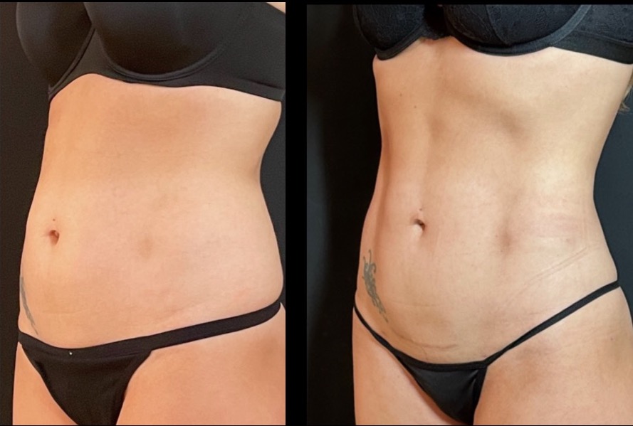 Abdominal Liposuction