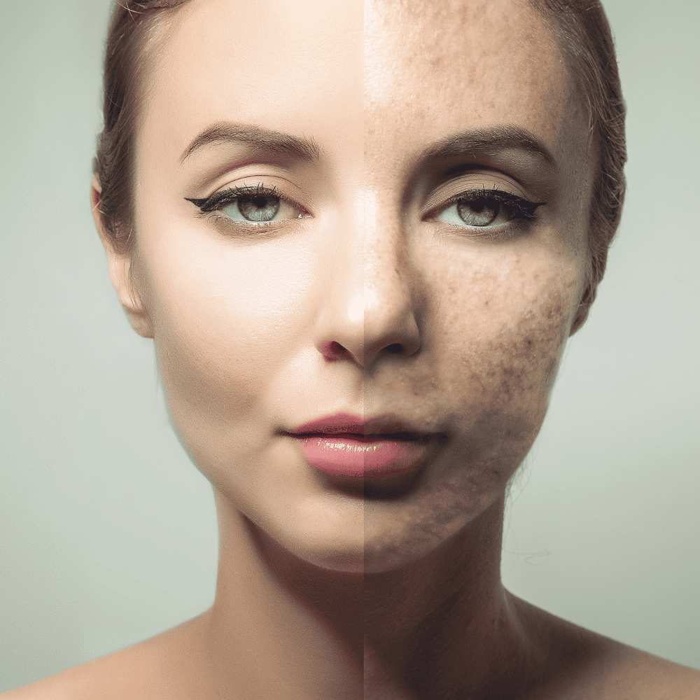 Skin Tag Removal with Liquid Nitrogen