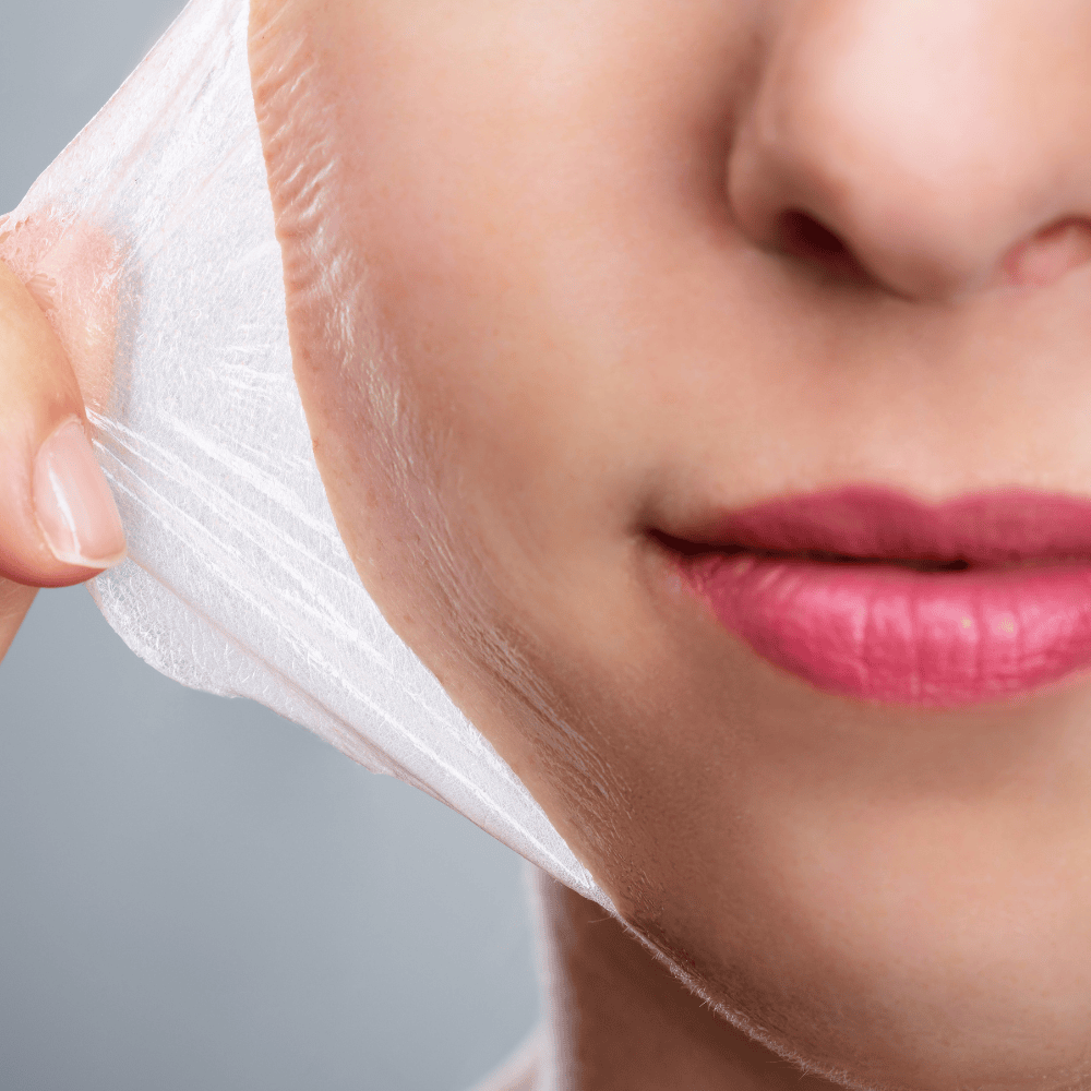 Chemical Peeling: Renew Your Skin from Within