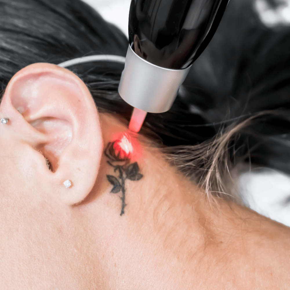 Tattoo Removal: Clear Skin, Fresh Start