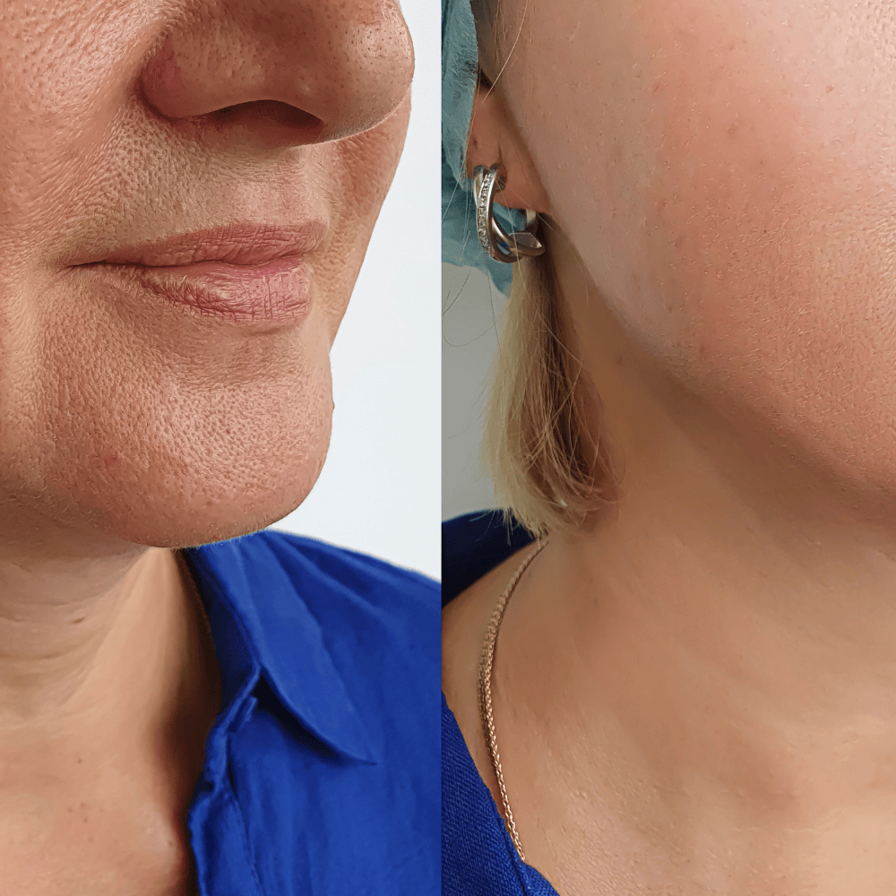 Sculptra vs. Hyaluronic Acid Fillers: The Next Level of Facial Rejuvenation