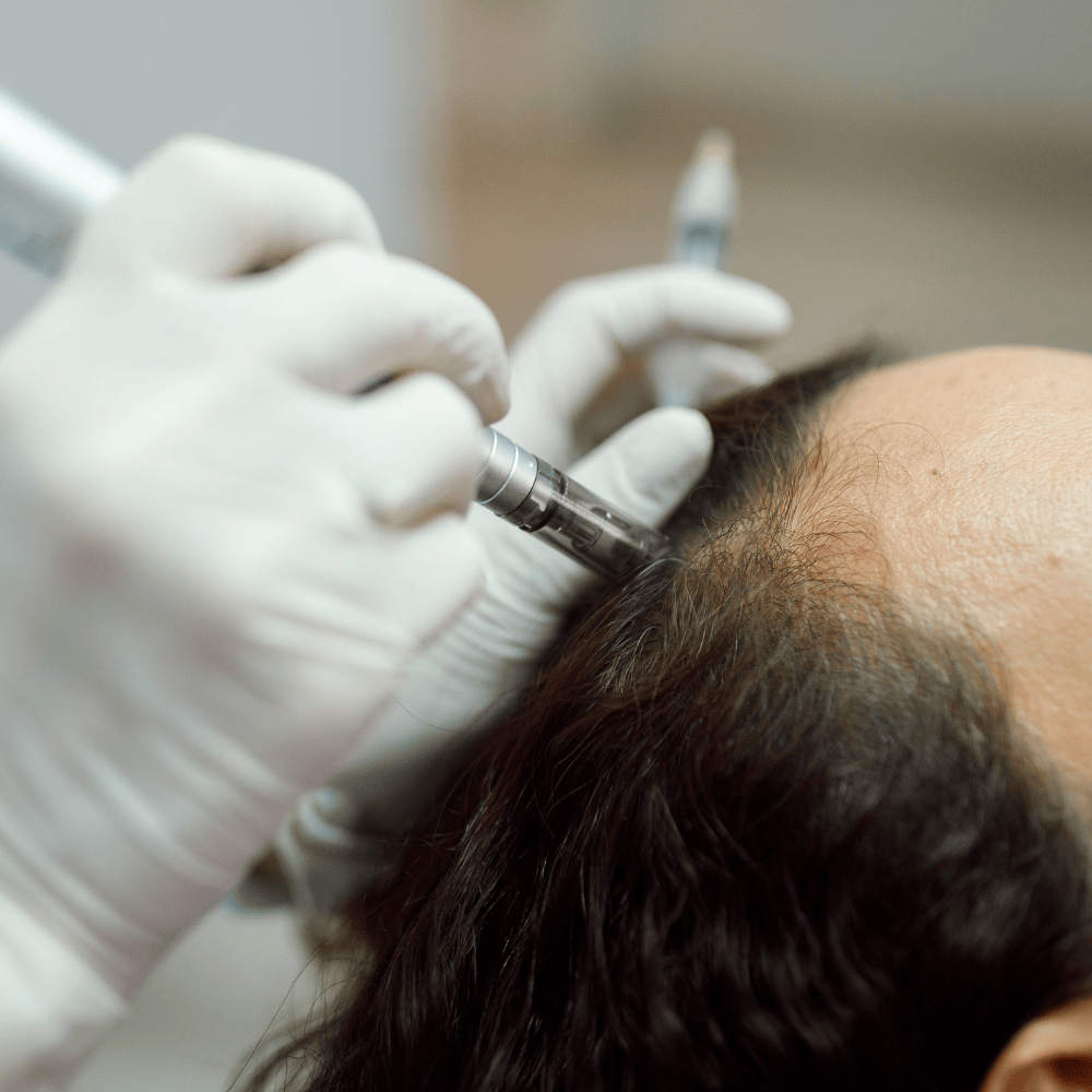 C-PRF Hair Restoration: A Natural Revolution in Hair Growth
